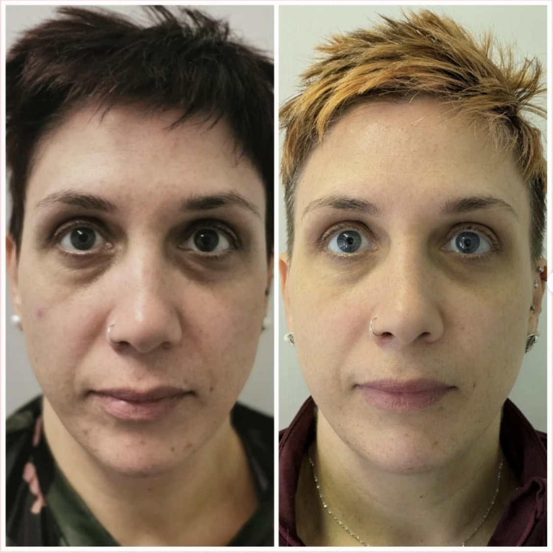 Before and After Treatment Result 2