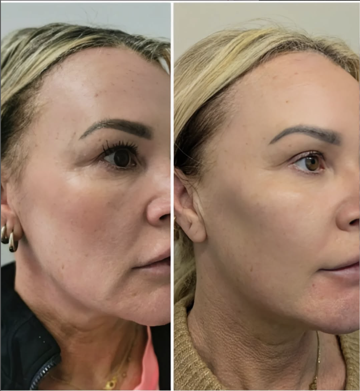 Before and After Treatment Result 5