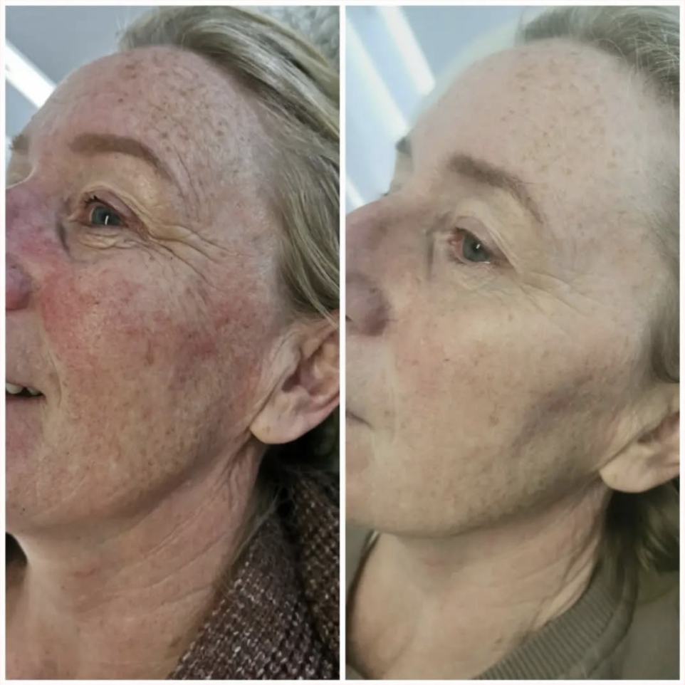 Before and After Treatment Result 7