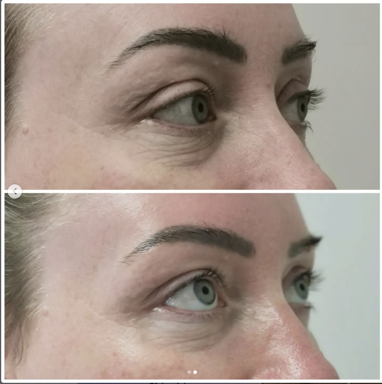 Before and After Treatment Result 11