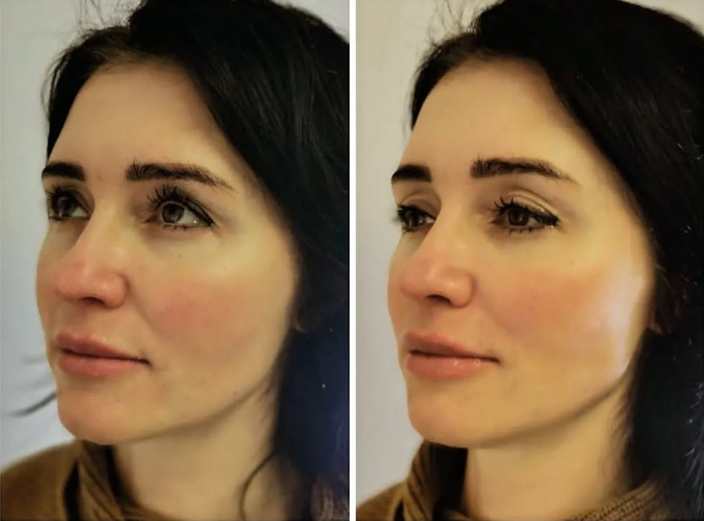 Lip Fillers Treatment Result by Lynn