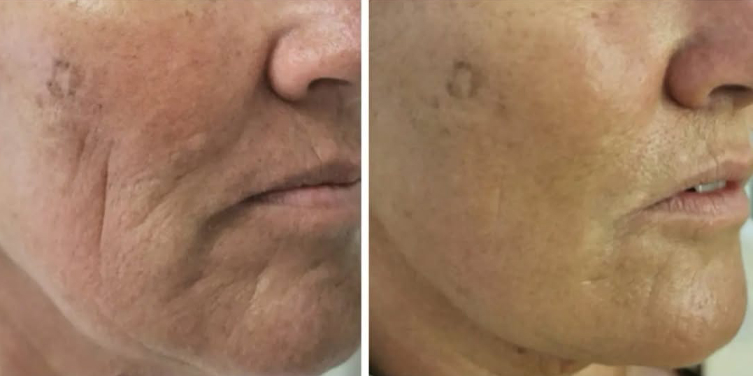Skin Boosters & Hyaluronic Acid Treatment Result